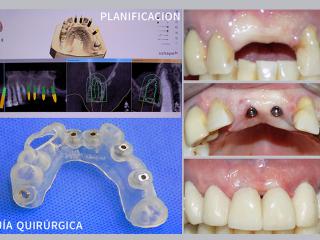 iMPLANTES WEB 44
